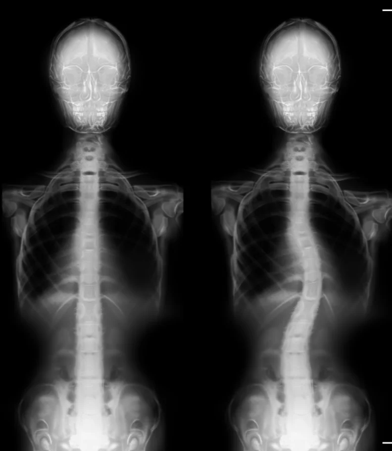 Scoliosis Durham
